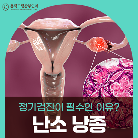 난소낭종이 발견됐다면, 지금 무엇부터 확인해야 할까요?