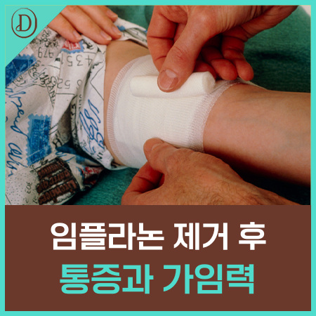 임플라논 삽입 통증, 제거하면 바로 임신이 가능할까요?